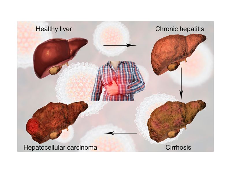 Four stages of liver disease illustration